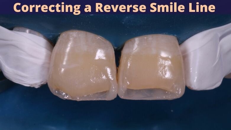 Correction of a Reverse Smile Line – Turning back the clock!