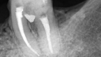Drilling treatment  using the new MTA Repair HP. Clinical Case Report