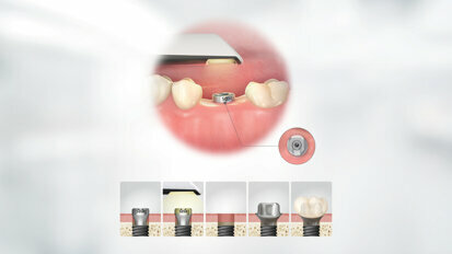 Osstem introduces the TS scan healing abutment for the European market