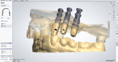 Realizzazione di un abutment implantare customizzato mediante CAD/CAM: una soluzione specifica per ogni caso clinico