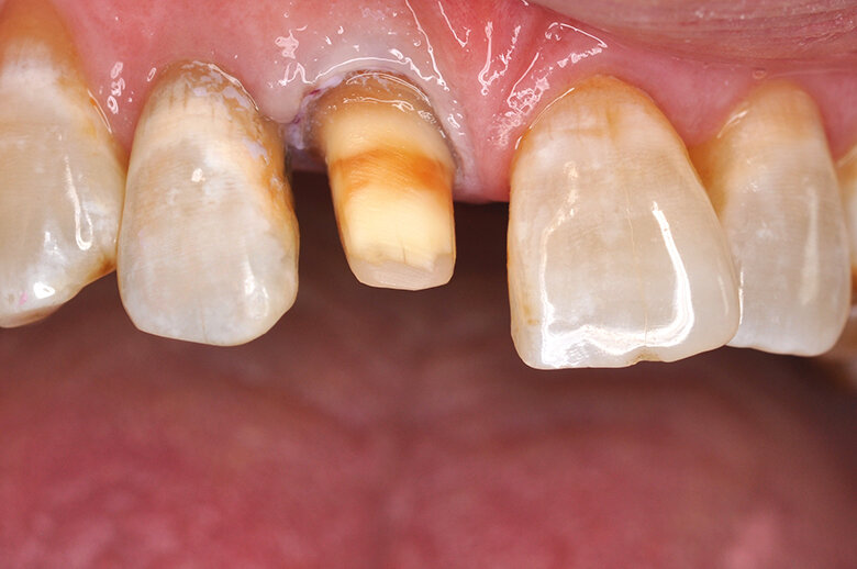 Fig. 1. Situación inicial: A fin de estabilizar el diente 11 de forma duradera, se procedió a su preparación para una corona de cerámica libre de metal.