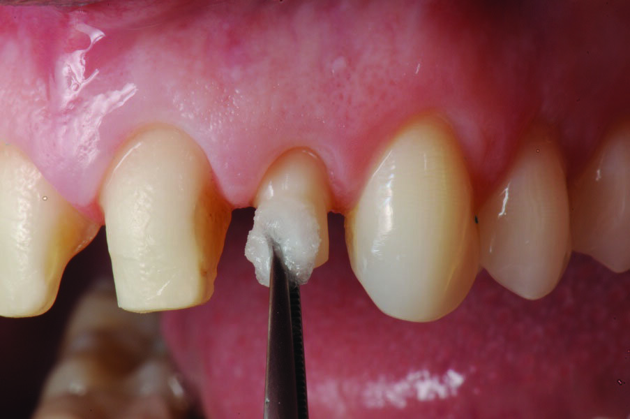 Fig. 13: Prior to cementing the crown the tooth preparation is mechanically cleaned with pumice paste, rinsed and gently dried to leave the surface slightly moist and shiny.