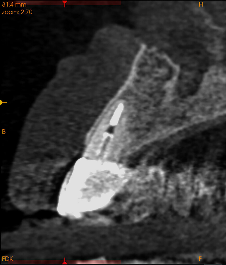 Fig. 14a:
The CBCT cross-sectional image revealed a favourable pre-op condition for a PET procedure.