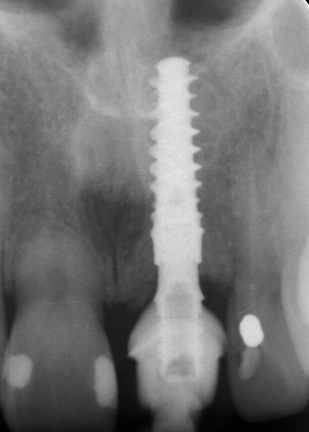 Fig. 29_Radiografia periapicale una settimana dopo l'intervento.