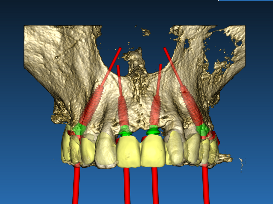 Fig. 2_Progetto digitale per il posizionamento di 4 impianti mono componente post estrattivi: si evidenzia la pianificazione protesicamente guidata grazie ad una ceratura virtuale. 