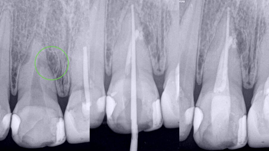 Figs. 7a–c: Radiographic sequence of the treatment performed in tooth #11. Initial radiograph. The root resorption and lateral radiolucent area were evident (a). Master cone fitting at the level of the complete working length (b). Completed root canal therapy (c).