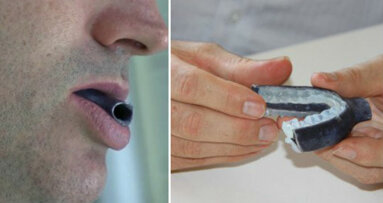 Apnea notturna: il nuovo boccaglio stampato in 3D può aiutare migliaia di pazienti