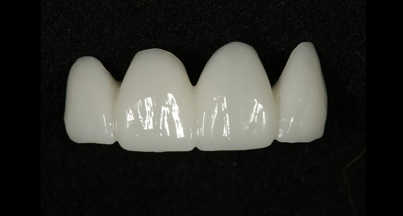 Fig. 14: Third PMMA prototype. A more softened look to the embrasures and incisal angles, with surface texture to delineate the individual lobes on the facial surface.