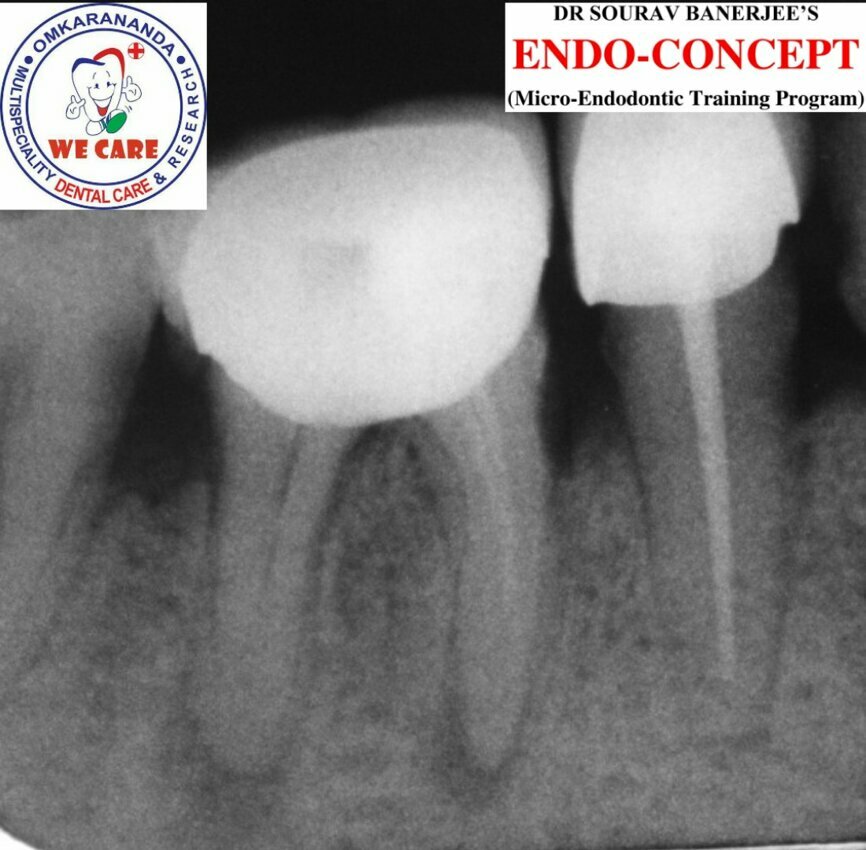 Fig.1a: Pre-op radiograph taken by the referring dentist.
