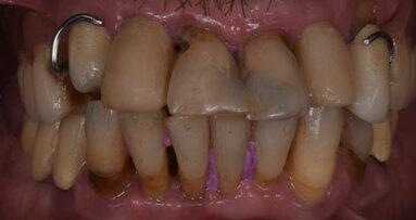 Risoluzione di un caso di parodontite aggressiva con preservazione crestale e chirurgia guidata