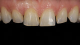 Fig. 2a. Dientes anteriores después del tratamiento de ortodoncia.