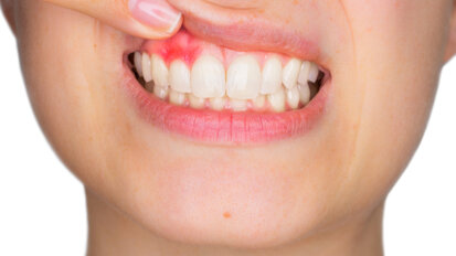Optimised diet for oral health reduces gingivitis