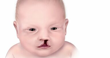 US children with orofacial clefts face healthcare barriers
