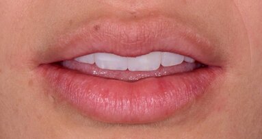 Realce de labios en la consulta odontológica