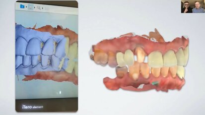 Come i flussi di lavoro digitali guidati dalla scansione intraorale migliorano la collaborazione tra studio odontoiatrico e laboratorio