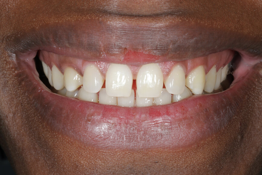 Fig. 8: Initial situation on smiling, lateral and frontal views.