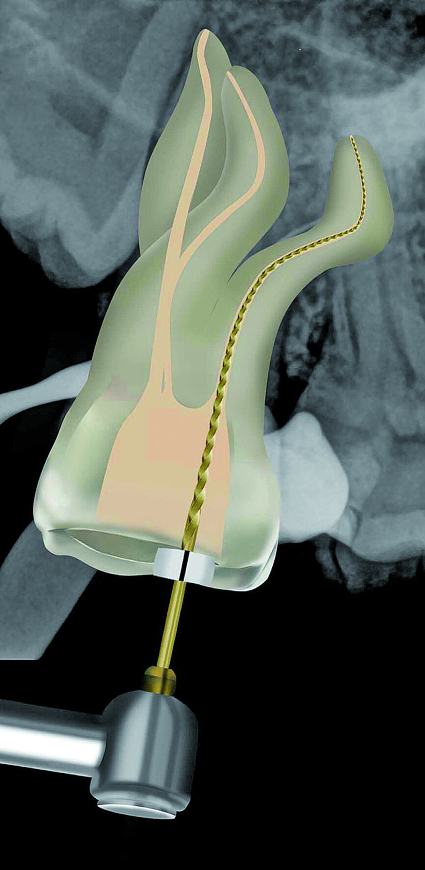 Fig. 25: A WaveOne Gold Glider was used in a reciprocating motion to further expand the glide paths in the two buccal root canals.