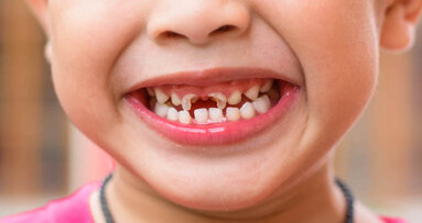 New study may help in better prevention of early childhood caries