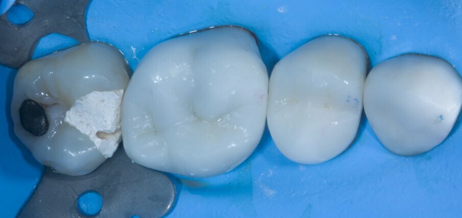 Fig. 1: Situation before treatment. There was a provisional restoration on tooth #27.