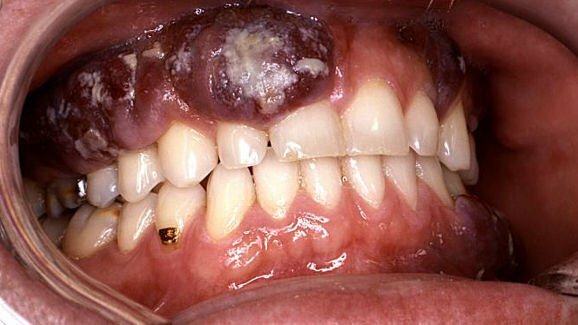 Les dérivés de bactéries parodontales peuvent provoquer la croissance de cancer de la bouche