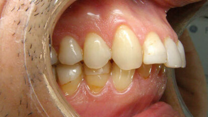 Les aligneurs en orthodontie : une solution à la portée de l’omnipraticien