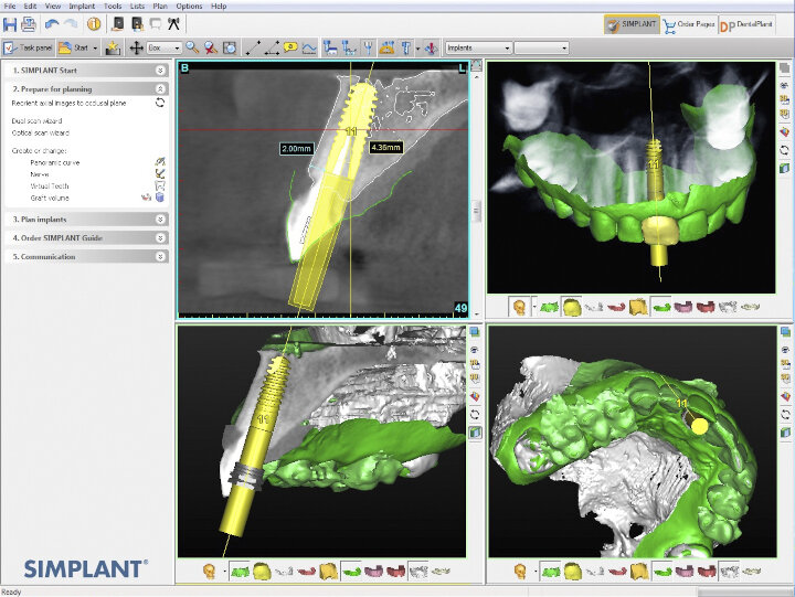 Fig. 5: Overlaying the CBCT and CEREC intra-oral scans, as well
as the planned implant position, in the Simplant software.