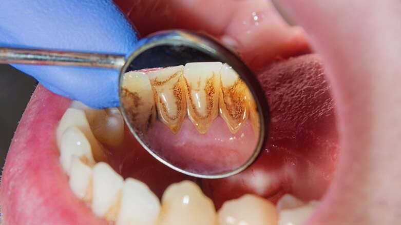 New research provides faster cheaper method to treat periodontitis