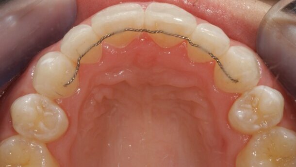 Orthodontics and Dental Implants: Aligning Teeth for Implant Success -  Binder Family Dental