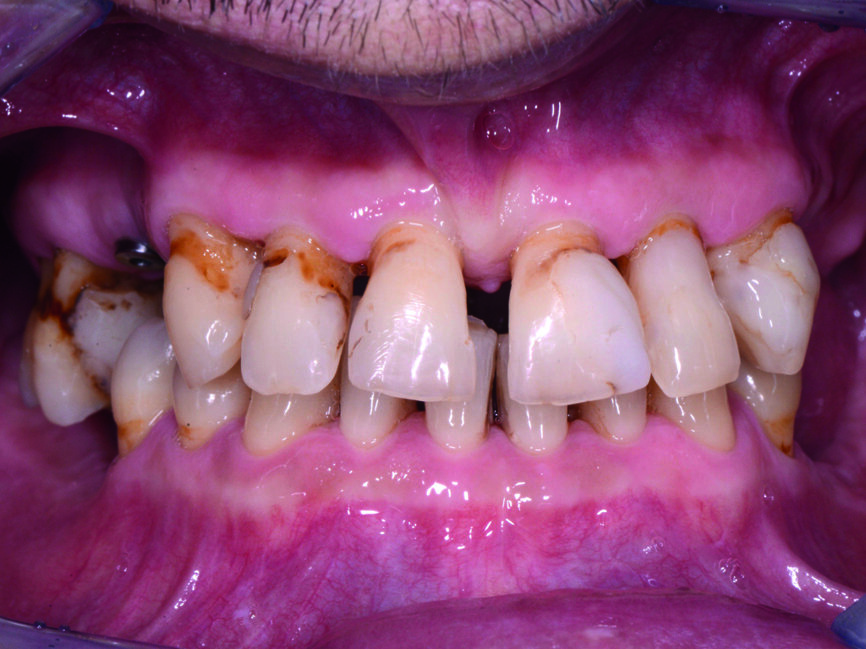 Fig. 2 : Vue intra-orale préopératoire. 