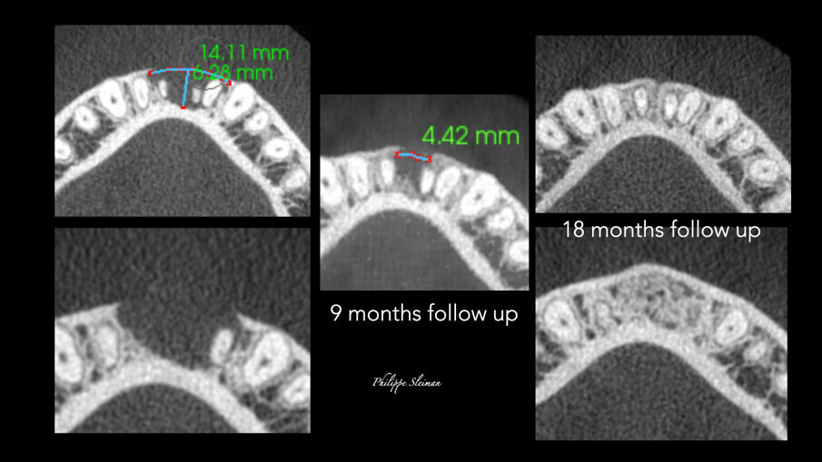Slike 7a–e: Poređenje horizontalnih prikaza i-CAT skeniranja snimljenih pre operacije (a i b) i tokom devetomesečnog praćenja (c) i 18-mesečnog praćenja (d i e), koji pokazuje potpuno zarastanje područja