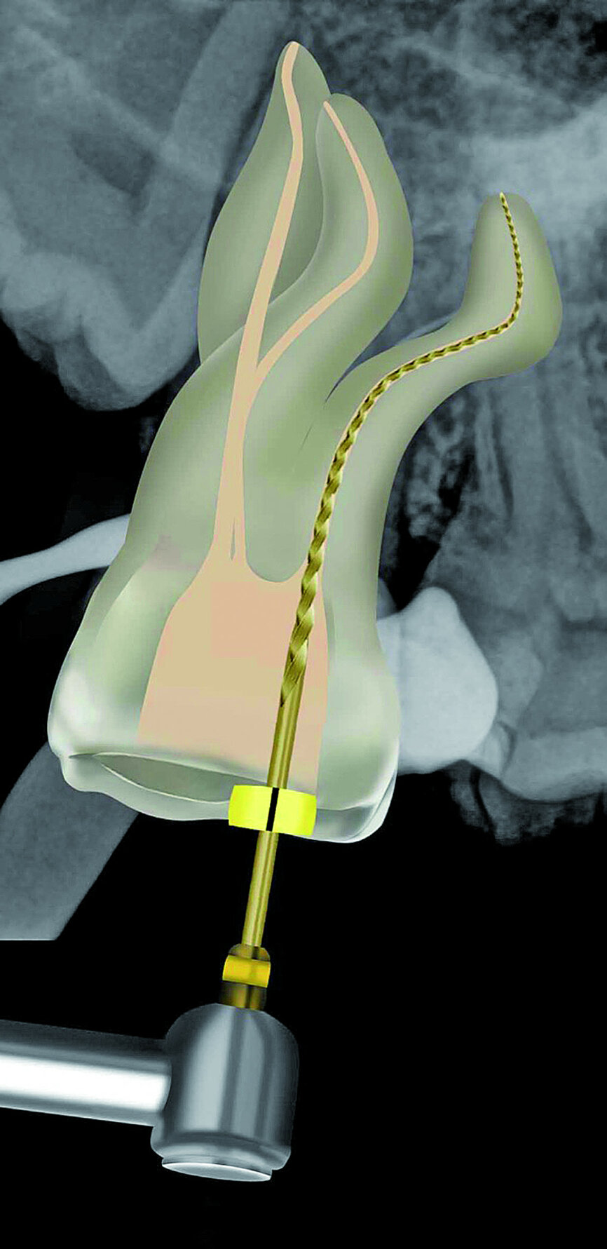 Fig. 27: The Small WaveOne Gold file (20/07) was used to complete canal preparation in the two buccal root canal systems.