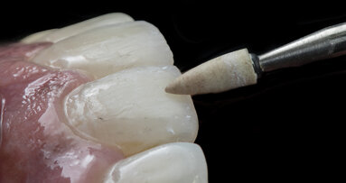 Predictable steps to Biomimetic Class IV restorations