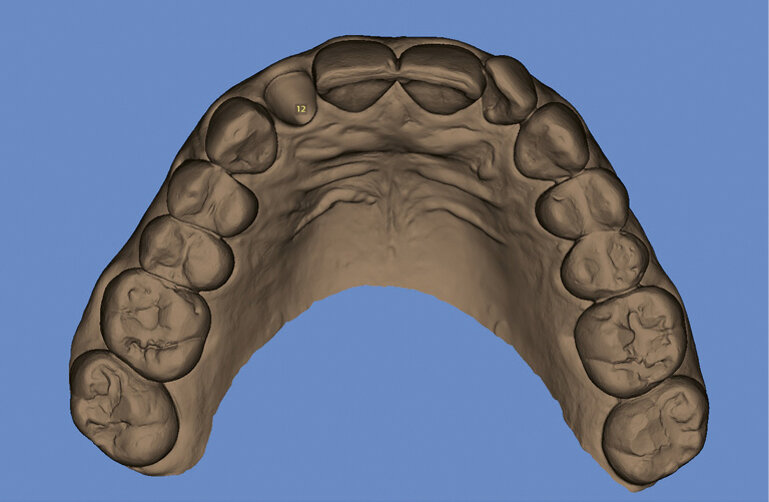 Fig. 4. Virtual extraction of the tooth in need of treatment