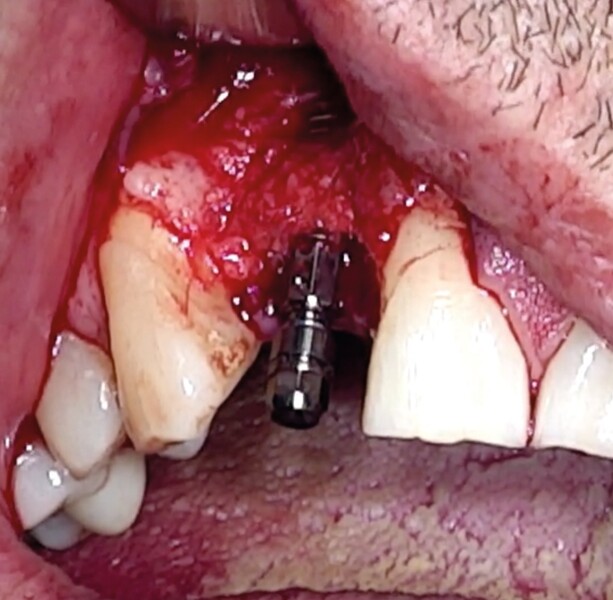 Fig. 17 : Recouvrement de l‘implant par l‘os de forage et l’os particulaire provenant de la carotte osseuse.