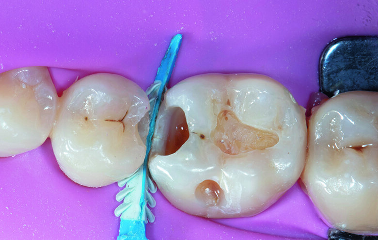 Fig. 2. Pre-wedging with removal of active decay on teeth #45, 46.