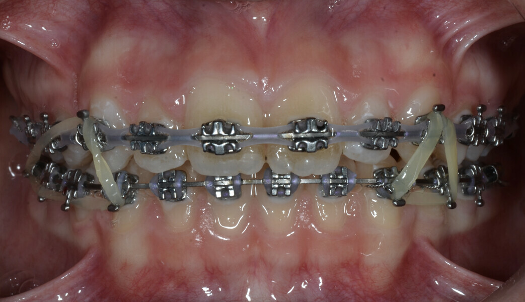 Fig. 1: Finishing the treatment with fixed orthodontic appliances.