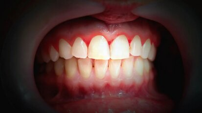 I přes dobrou ústní hygienu může lokální zánět dásní postihnout vzdálená zdravá místa v ústech
