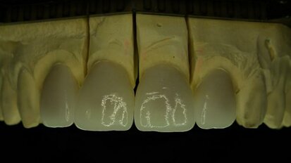 Lithium disilicate—An effective solution for aesthetically demanding indications