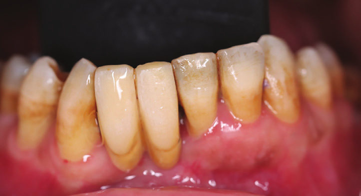 Figure 1: Preoperative intraoral view showing the ex- tended Maryland bridge compressing and replacing the loss of gum in the area.