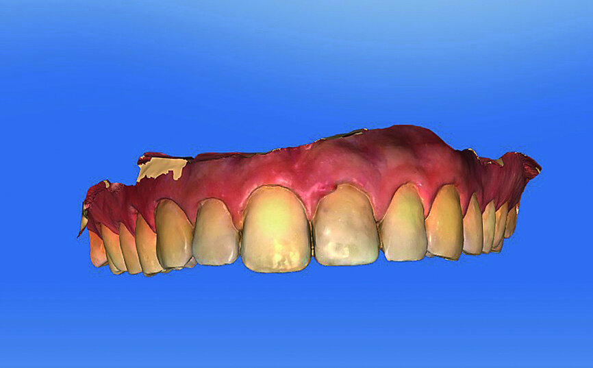 Fig. 4: Tooth #21 was deleted in CEREC to simulate the initial post-op situation.