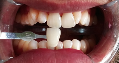 Zahnaufhellung nach Zahnreinigung wird zur Behandlung für Jedermann