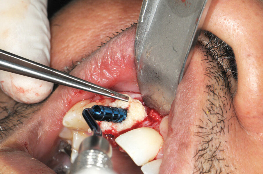 Fig. 2: Following extraction, ‘gummy bone’ is placed into the socket for preservation of the site.