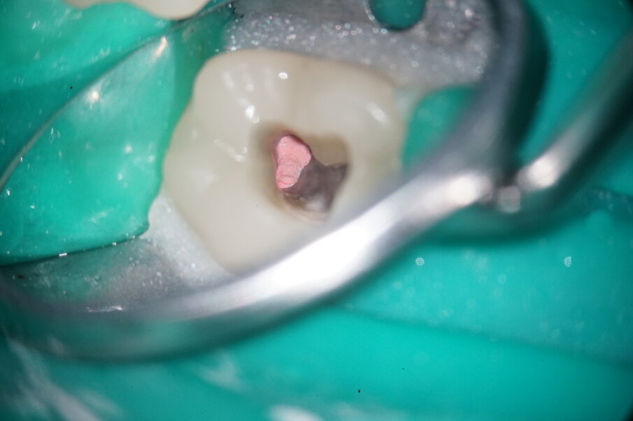 Fig. 11: Root canal filling distally.