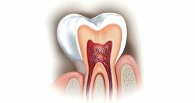 Nadwrażliwość zębiny – uproszczone procedury