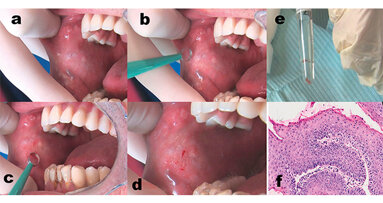 La microbiopsia per gli odontoiatri un ausilio diagnostico nella pratica clinica quotidiana