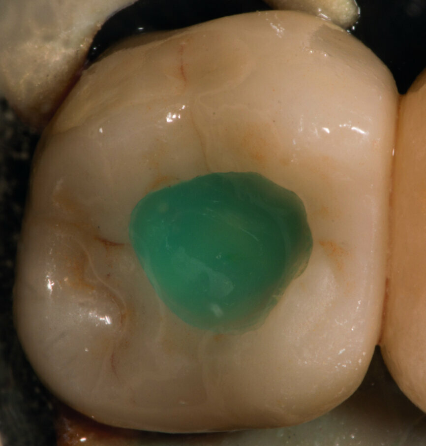 Fig. 4 : L’orifice a été provisoirement fermé avec un matériau d’obturation hygroscopique provisoire et recouvert d’un composite fluide de couleur bleue. 
