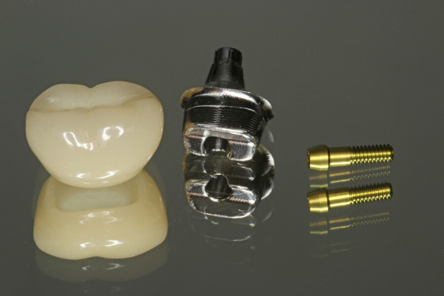 Fig. 11: Abutment and provisional crown manufactured within one week of surgery.