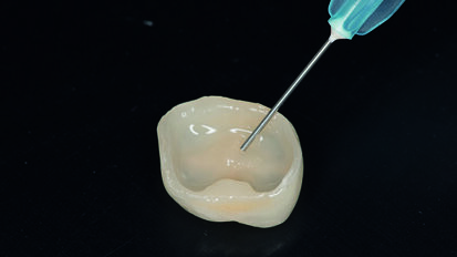Core Build-Up using Dentsply Sirona’s SDR® Plus