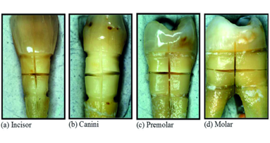 Modification of tooth neck dentin with a diode laser for desensitisation