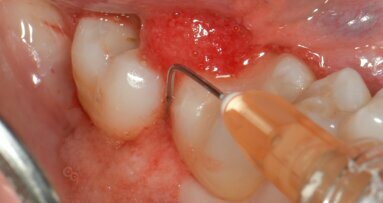 Utilizzo di un nuovo hydrogel collagenico nel trattamento di tasche parodontali: una case series